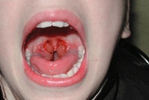 Simptomele și tratamentul de inflamare a laringelui (laringe) Simptomele și tratamentul inflamației gâtului