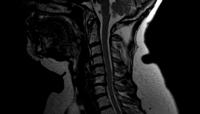 Spondylarthrosis simptome pleasna si tratament (simptome) Spondylarthrosis simptome la nivelul gatului si tratament