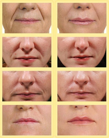 injecții de frumusețe ca Radiesse sunt și dacă puteți face la domiciliu foto și video (ca) injecții de frumusețe ca Radiesse sunt și dacă puteți face la domiciliu foto și video