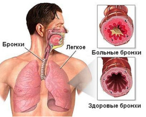 Inflamarea bronhiilor (bronșită epuizant tuse) inflamația bronhiilor