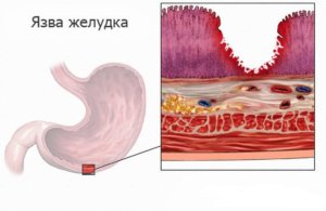 ulcer gastric cronic - simptome, cauze, dieta, tratament (stomac) ulcer gastric cronic - simptome, cauze, dieta, tratament