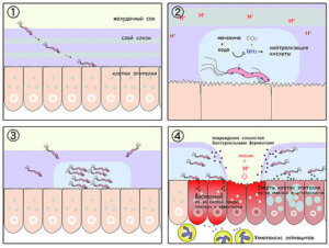 ulcer gastric cronic - simptome, cauze, dieta, tratamentul (cronic) ulcer gastric cronic - simptome, cauze, dieta, tratament