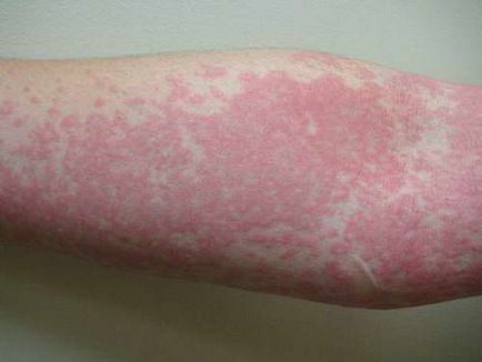 Alergia - cum de a trata alergii, articol despre diferitele tipuri de reacții alergice (alergie) Alergia - cum pentru tratarea alergiilor, articolul despre diferitele tipuri de reacții alergice