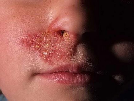 Alergia - cum pentru tratarea alergiilor, articolul despre diferitele tipuri de reacții alergice (urticarie medicul recomandă) Alergia - cum pentru tratarea alergiilor, articolul despre diferitele tipuri de reacții alergice