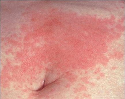 Alergia - cum pentru tratarea alergiilor, articolul despre diferitele tipuri de reacții alergice (alergii alergii ale pielii) Alergia - cum pentru tratarea alergiilor, articolul despre diferitele tipuri de reacții alergice