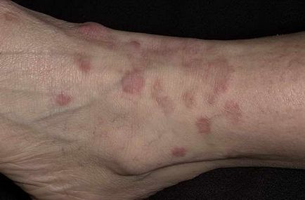 Alergia - cum pentru tratarea alergiilor, articolul despre diferitele tipuri de reacții alergice (urticarie medicul recomandă) Alergia - cum pentru tratarea alergiilor, articolul despre diferitele tipuri de reacții alergice