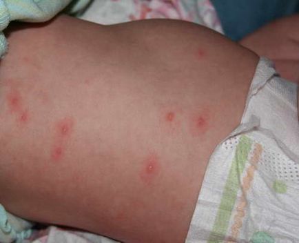 Alergia - cum pentru tratarea alergiilor, articolul despre diferitele tipuri de reacții alergice (urticarie medicul recomandă) Alergia - cum pentru tratarea alergiilor, articolul despre diferitele tipuri de reacții alergice