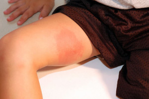 Alergia la albine (albine) Alergic la albine
