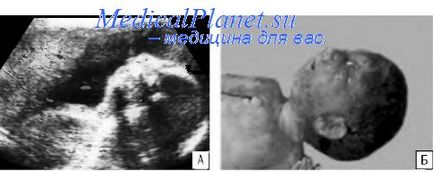 Anomalii ale maxilarului inferior (anomalii mandibulare) anomalii mandibulare