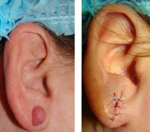 Cauzele ateromului earlobe (glandelor sebacee conductă) Cauzele ateromul ale lobului urechii