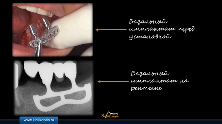 implantare bazale (bazal) implanturile bazale