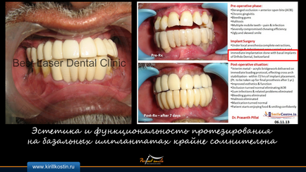 implantarea Basal (implantarea implanturilor elicoidale bazale) implanturile bazale