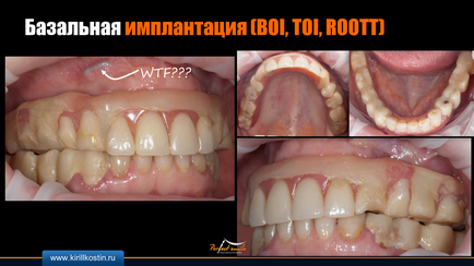 implantarea Basal (implantare) implanturile bazale