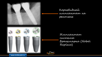 implantare bazale (grefare osoasă) implanturile bazale