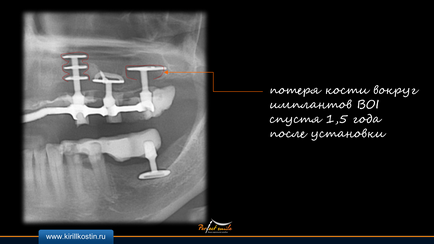 implantarea Basal (implantarea implanturilor elicoidale bazale) implanturile bazale