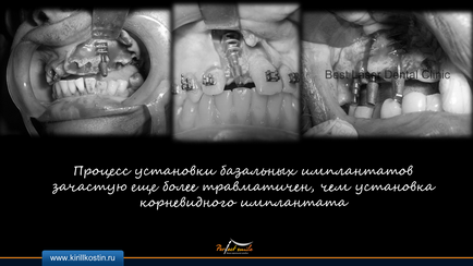 implantare bazale (grefare osoasă) implanturile bazale