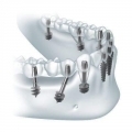 Prețul de implantare bazală de 35.000 de ruble (dinți) Prețul de implantare bazală de 35.000 ruble