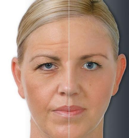 Botox - este că prețul de injecții cu Botox, comentarii (minute se clătește cu călduță) Botox - este faptul că prețul de injectiile cu Botox, comentarii