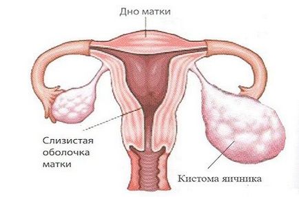Chistadenomul tipuri de ovar (seroase, papilar, mucinos, etc.), simptome, diagnostic,