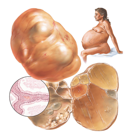 Chistadenomul tipuri de ovar (seroase, papilar, mucinos, etc.), simptome, diagnostic,