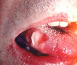 Dekubitalnaya ulcer oral - cauze, simptome, diagnostic și tratament (diagnostic) Dekubitalnaya ulcer oral - cauze, simptome, diagnostic și tratament