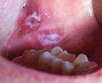 Dekubitalnaya ulcer oral - cauze, simptome, diagnostic și tratament (cavitate) Dekubitalnaya ulcer oral - cauze, simptome, diagnostic și tratament