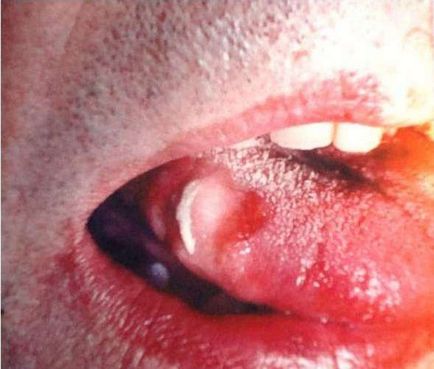 Dekubitalnaya ulcer ale mucoasei bucale cauze, tratament (bolilor orale și dentare) Dekubitalnaya ulcer mucoasei bucale cauze, tratament