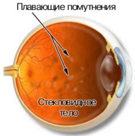 Distrugerea soluției ochiului vitros este găsit