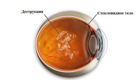 Ochii floater - simptome și tratament