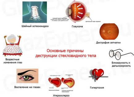 Ochii floater - simptome și tratament