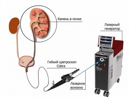 Fragmentarea de pietre la rinichi prin feedback-ul cu laser si rezultate (rezultate) litotripsie cu laser în rinichi și recenzii rezultate