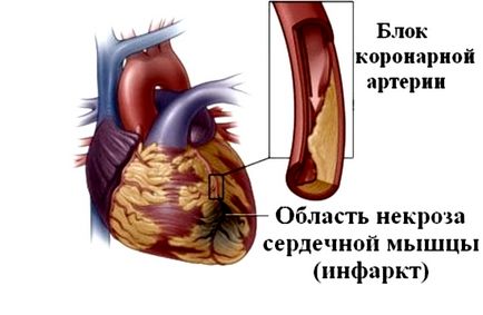 ECG în infarctul miocardic (miocard) ECG în infarctul miocardic