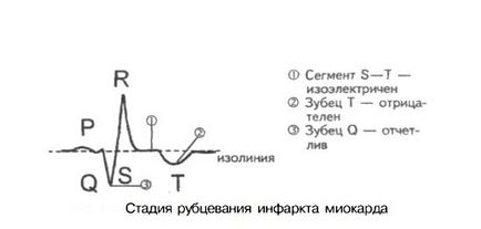 ECG în infarctul miocardic (miocard) ECG în infarctul miocardic