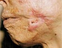 Epiteliom - cauze, simptome, diagnostic și tratament (tratament) Epitelioame - cauze, simptome, diagnostic și tratament