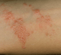 Terapia Hyposensitization 2 (5-10 soluție zilnic) Terapia Hyposensitization 2