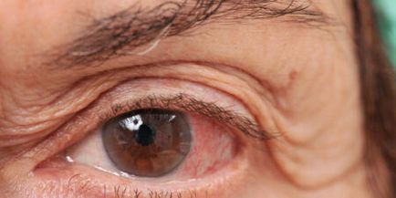 Glaucomul remedii tratament popular si preventiv (glaucom) Tratamentul de glaucom remedii populare și de prevenire