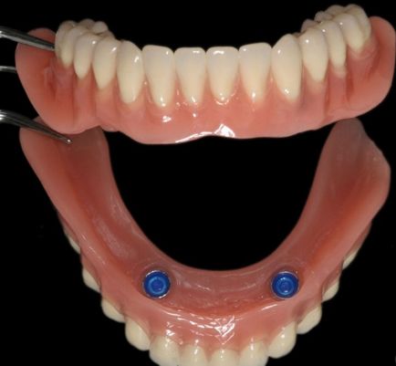 Implanturile dentare în întrebări și răspunsuri (Chestiuni) implanturi dentare întrebări și răspunsuri