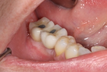 Implanturile dentare în întrebări și răspunsuri (implanturi) implanturi dentare întrebări și răspunsuri