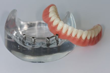 Implanturile dentare în întrebări și răspunsuri (coroane) implanturi dentare întrebări și răspunsuri