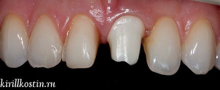 Implanturile dentare în întrebări și răspunsuri (implanturi) implanturi dentare întrebări și răspunsuri