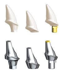 Implanturile dentare în întrebări și răspunsuri (Chestiuni) implanturi dentare întrebări și răspunsuri
