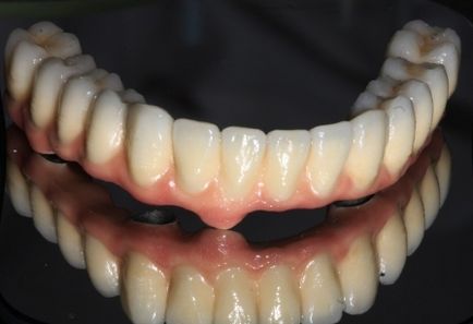 Implanturile dentare în întrebări și răspunsuri (implantării) implanturi dentare întrebări și răspunsuri
