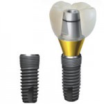 Implanturi implantium (implanturi implantium dentium implantium) implanturi implantium