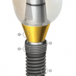 Implanturile implantium (implantium) implanturi implantium