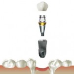 Implanturi implantium (implanturi implantium dentium implantium) implanturi implantium