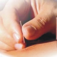 Accident vascular cerebral Acupunctura - bisturiu - portal web medical (tratament) Accident vascular cerebral tratament acupunctura - bisturiu - informații medicale și portal educațional