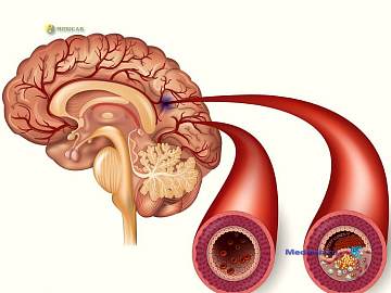 accident vascular cerebral simptome, tratamentul si prevenirea bolii (bolilor) accident vascular cerebral simptome, tratamentul și profilaxia bolilor