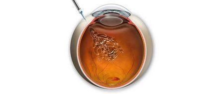 injecție intravitroasă la cele mai bune preturi de la Moscova! (Ochi) injecție intravitroasă la cele mai bune preturi de la Moscova!