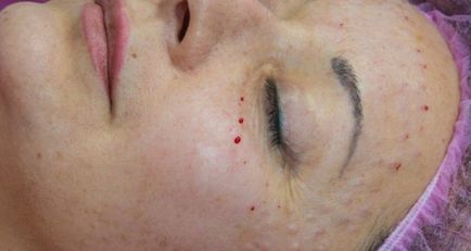 Cum să eliminați echimoze după Mezoterapia (după) Cum de a elimina echimoze după mezoterapie