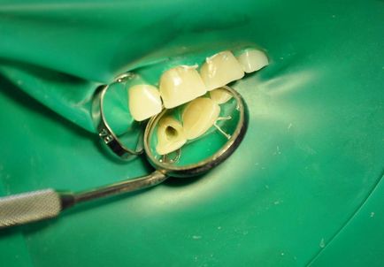 Caz clinic de albire complexe - terapie - stiri si articole pentru stomatologie - (umbră) Caz clinic de dinți complexe de albire - terapie - stiri si articole pentru stomatologie -